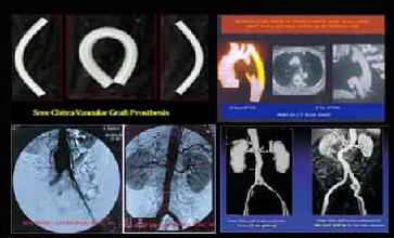 Vascular Graft